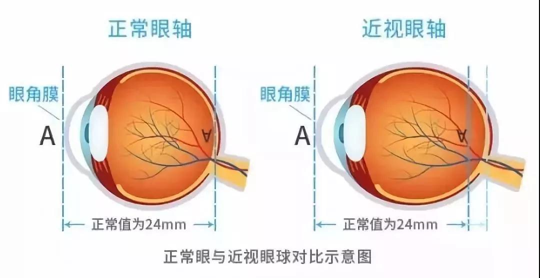 高度近视,一个显著的特征是眼轴变长,眼球从圆形向椭圆形转变,这时