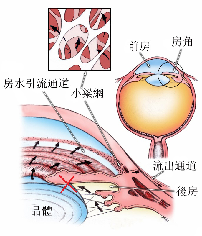 别掉以轻心白内障和青光眼可以相互影响