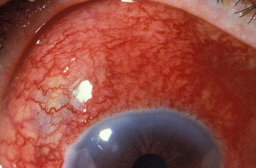 风湿,性,关节炎,可以,预测,阴雨,也,有可能,是,