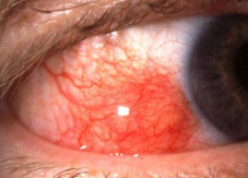 风湿,性,关节炎,可以,预测,阴雨,也,有可能,是,