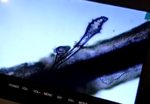 眼睛,干痒,、,红肿,脱,睫毛,居然,是,螨虫,