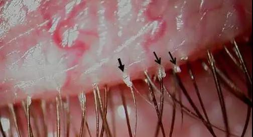 眼睛,干痒,、,红肿,脱,睫毛,居然,是,螨虫,