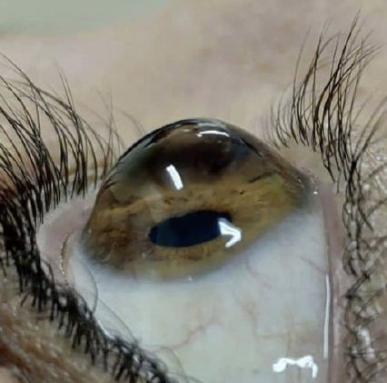 被,误解,的,高度,近视,散光,—,圆锥,角膜,