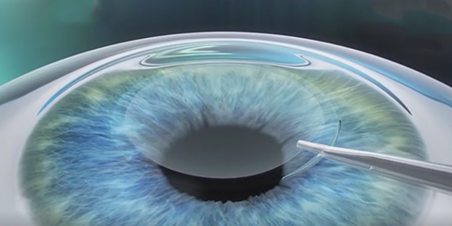 被,误解,的,高度,近视,散光,—,圆锥,角膜,