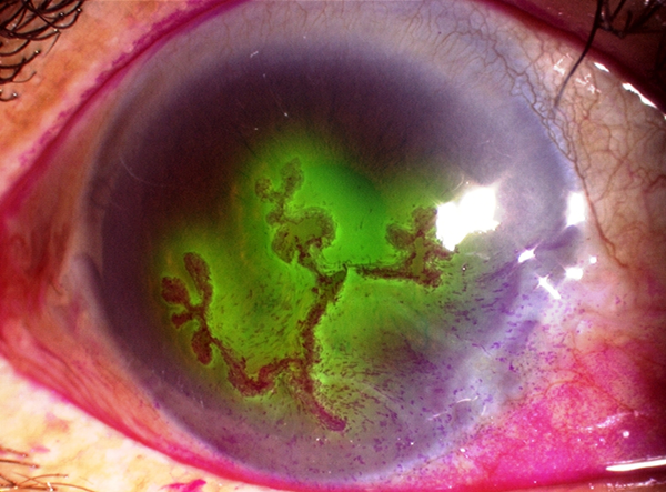 角膜,上,长出,“,树枝,”,小心,是,得了,树,的,