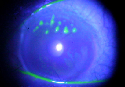 角膜,上,长出,“,树枝,”,小心,是,得了,树,的,