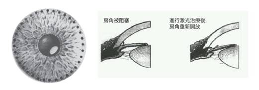 急性青光眼,前房穿刺,眼科专科医院