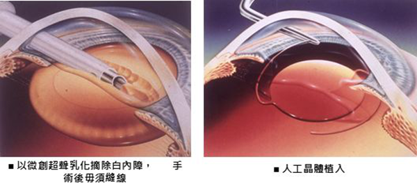 青光眼治疗,青光眼治疗方法