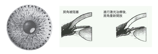 青光眼治疗,青光眼治疗方法