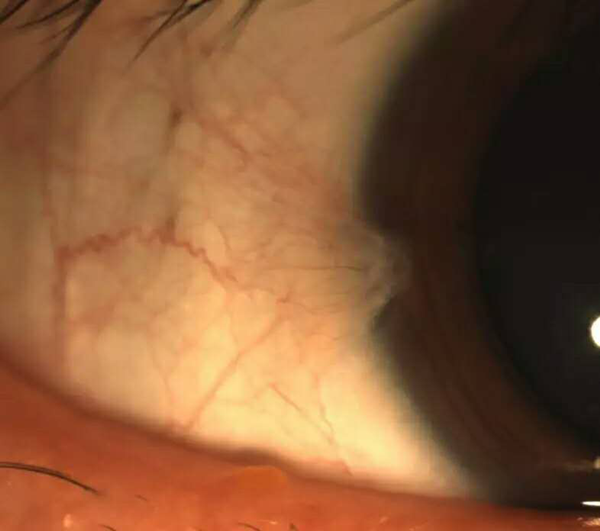 白内障,翼状胬肉,深圳希玛林顺潮眼科医院