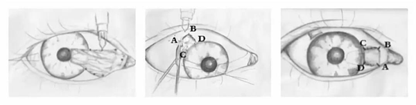 白内障,翼状胬肉,深圳希玛林顺潮眼科医院
